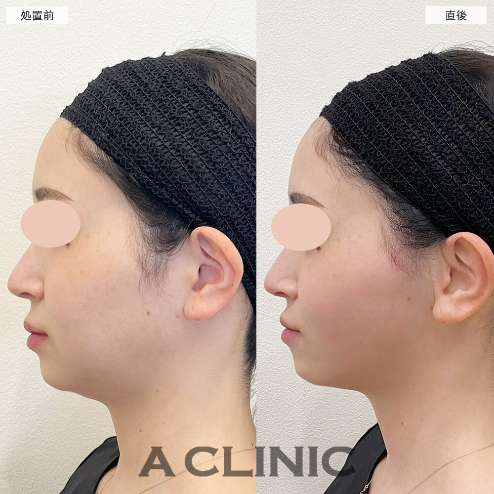 A式トリニティリフトでフェイスラインがナチュラルに整いました！こちら処置前と直後の症例です(20代女性)