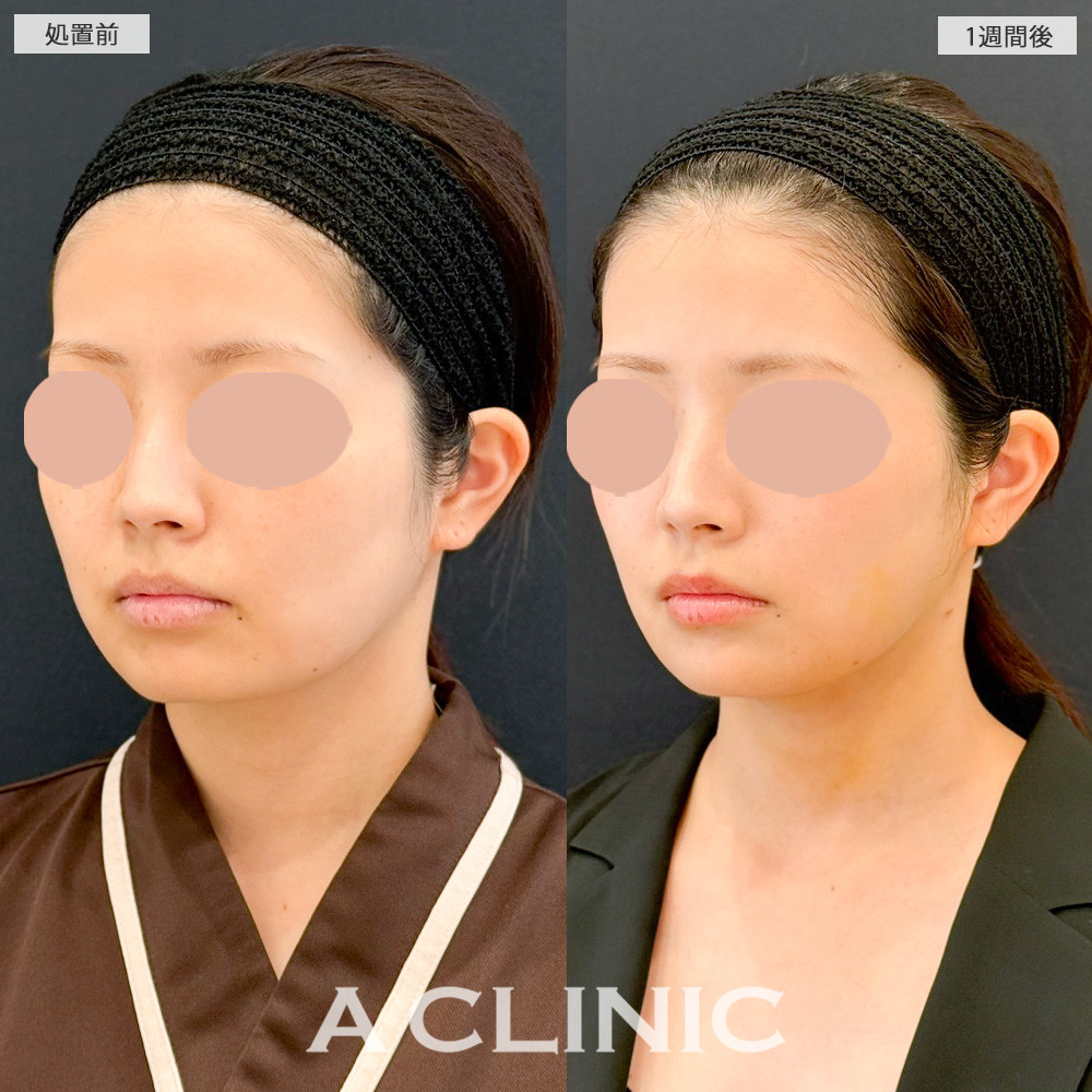 1day小顔脂肪吸引から1週間後なのに腫れるどころかスッキリ感を実感！こちら処置前と1週間後の症例です(20代女性)