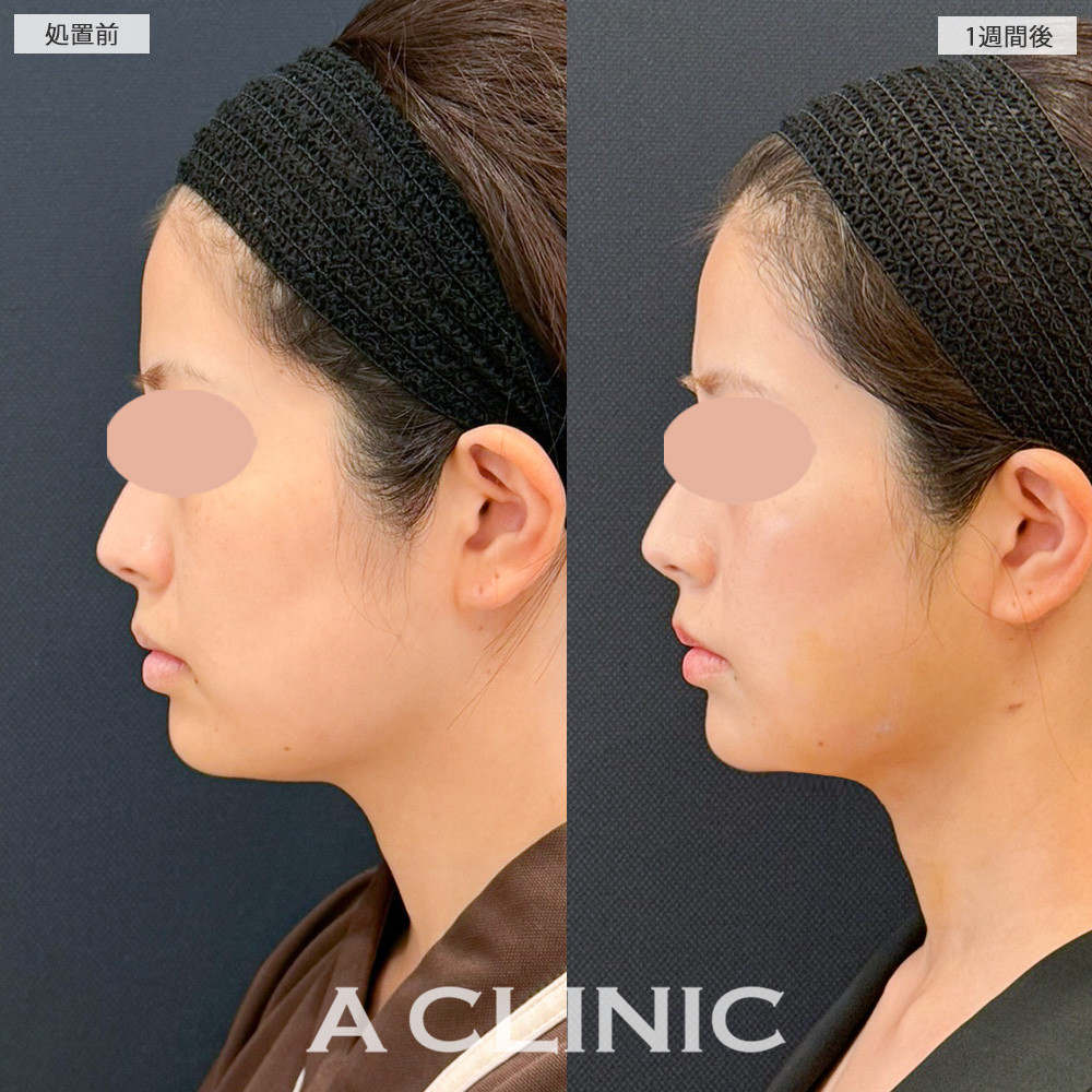 1day小顔脂肪吸引から1週間後なのに腫れるどころかスッキリ感を実感！こちら処置前と1週間後の症例です(20代女性)