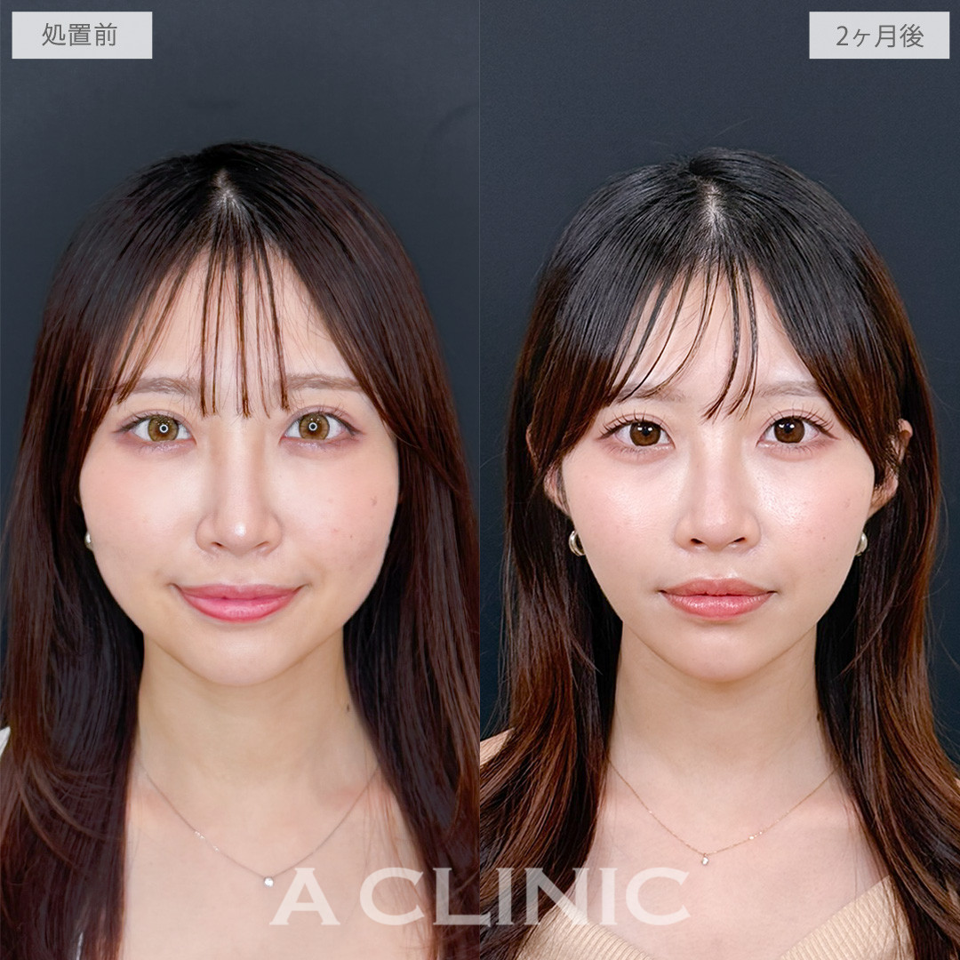 1day小顔脂肪吸引でお顔のボリュームを無くしより美人度アップ！処置前と2ヶ月後の症例です(20代女性)