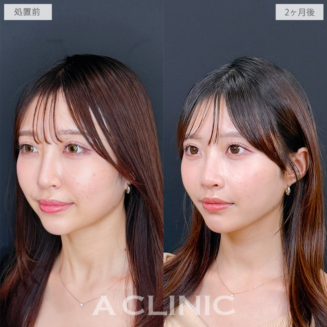 1day小顔脂肪吸引でお顔のボリュームを無くしより美人度アップ！処置前と2ヶ月後の症例です(20代女性)