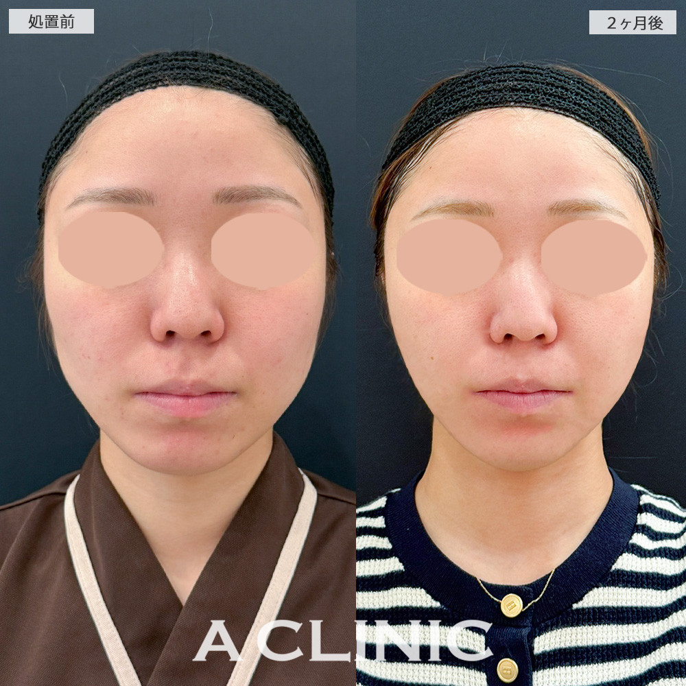 1day小顔脂肪吸引であご下がスッキリ整いナチュラルに変化しました！処置前と2ヶ月後の症例です(20代女性)
