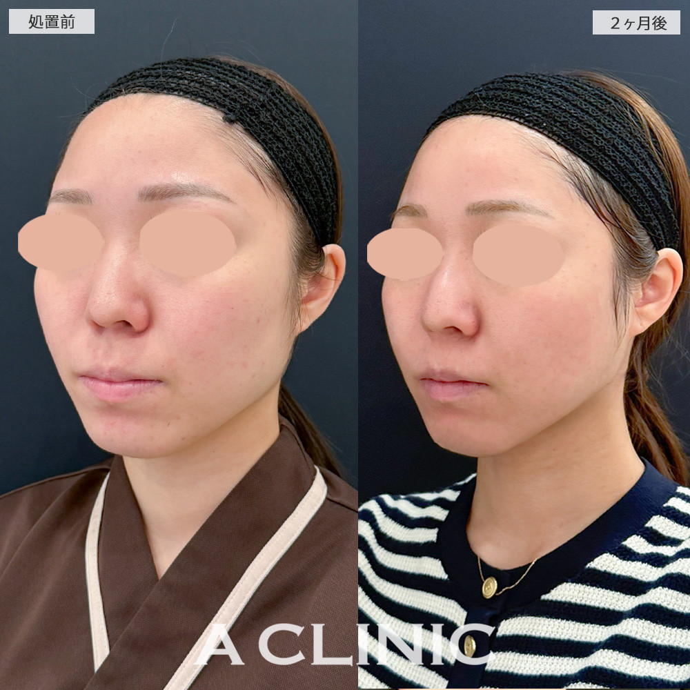 1day小顔脂肪吸引であご下がスッキリ整いナチュラルに変化しました！処置前と2ヶ月後の症例です(20代女性)