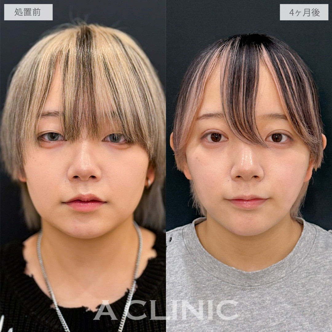 1day小顔脂肪吸引とあごへのヒアルロン酸注入でふっくら感輪郭からシャープな輪郭へ！処置前と4ヶ月後の症例です(20代女性)