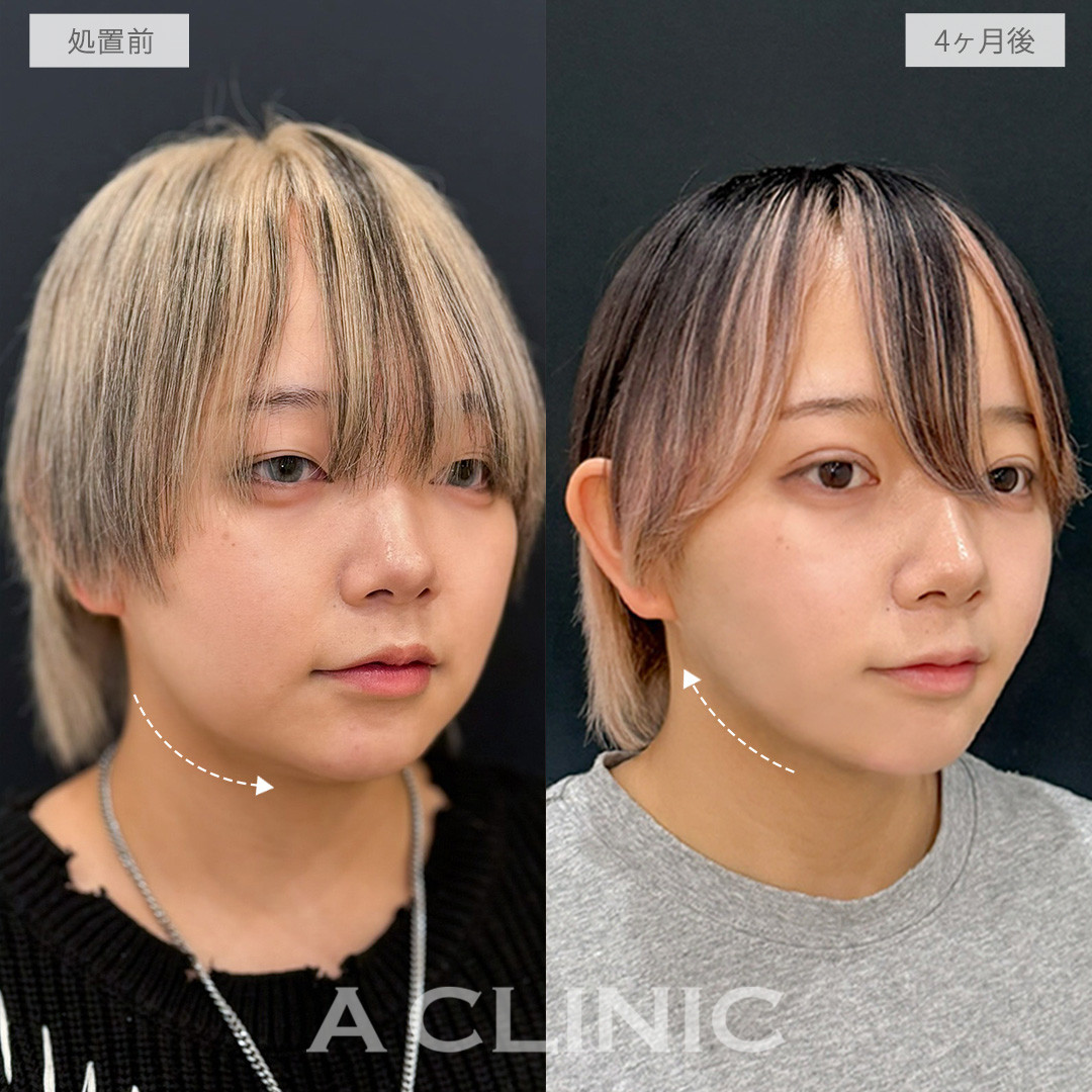1day小顔脂肪吸引とあごへのヒアルロン酸注入でふっくら感輪郭からシャープな輪郭へ！処置前と4ヶ月後の症例です(20代女性)