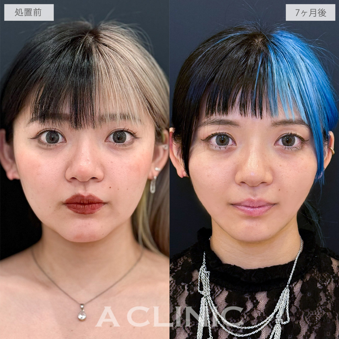 1day小顔脂肪吸引で輪郭の重心を上げたすっきり小顔へ！こちら処置前と7ヶ月後の症例です(30代女性)