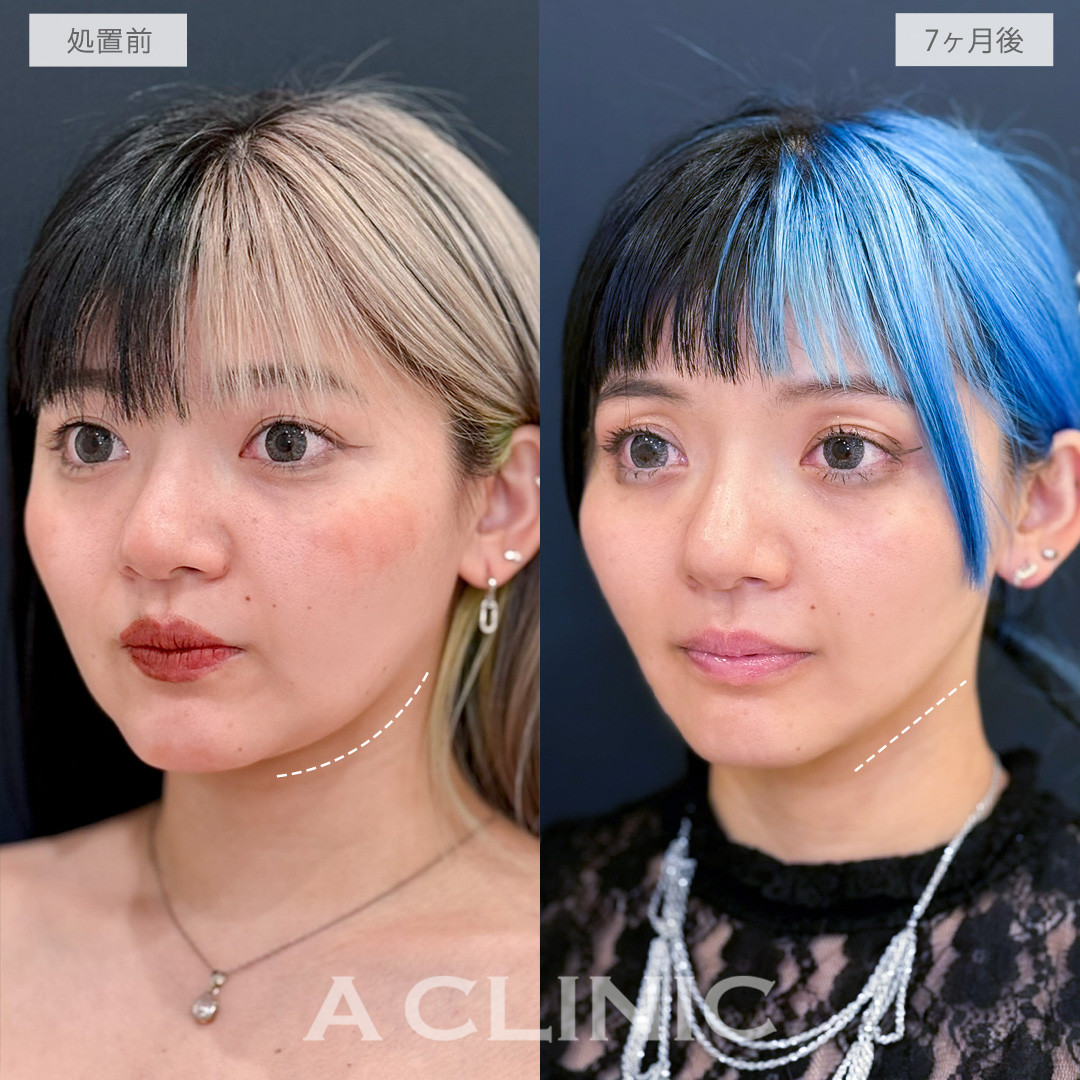 1day小顔脂肪吸引で輪郭の重心を上げたすっきり小顔へ！こちら処置前と7ヶ月後の症例です(30代女性)