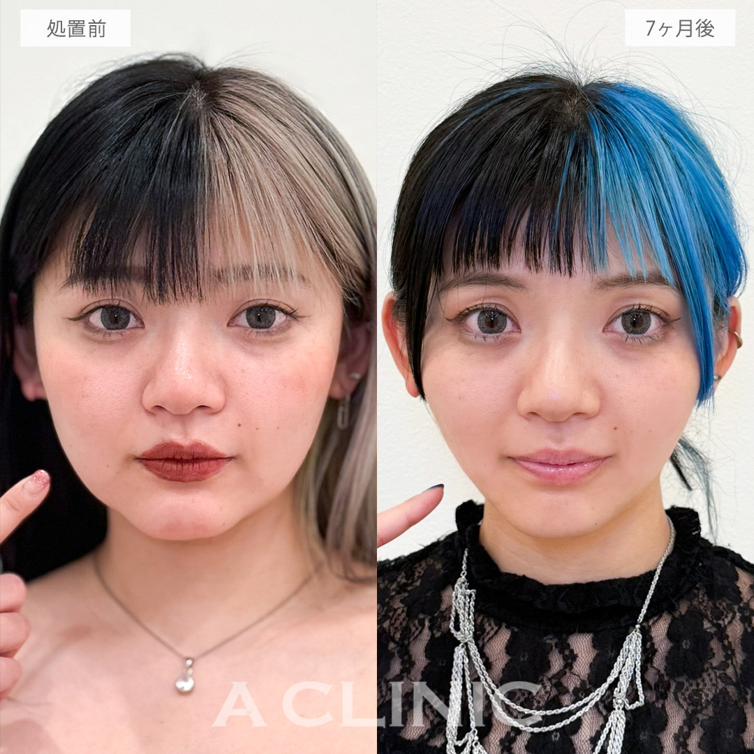 1day小顔脂肪吸引で輪郭の重心を上げたすっきり小顔へ！こちら処置前と7ヶ月後の症例です(30代女性)