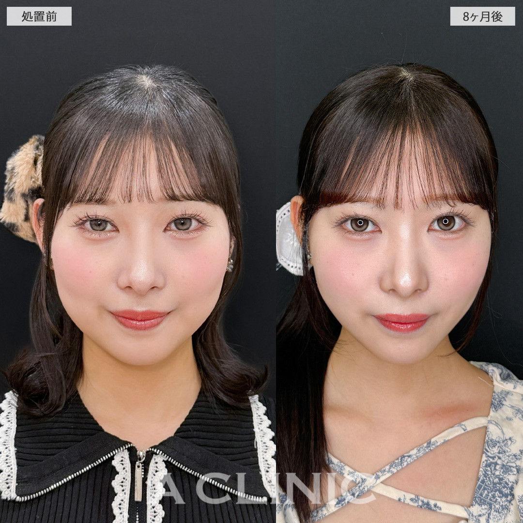 1day小顔脂肪吸引で輪郭が整って洗練された印象になりました！こちら処置前と8ヶ月後の症例です(20代女性)