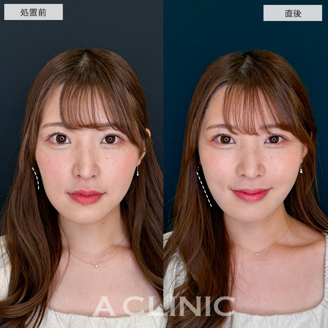 1day小顔脂肪吸引は直後から腫れ最小限で小顔に！こちら処置前から直後の症例です(20代女性)