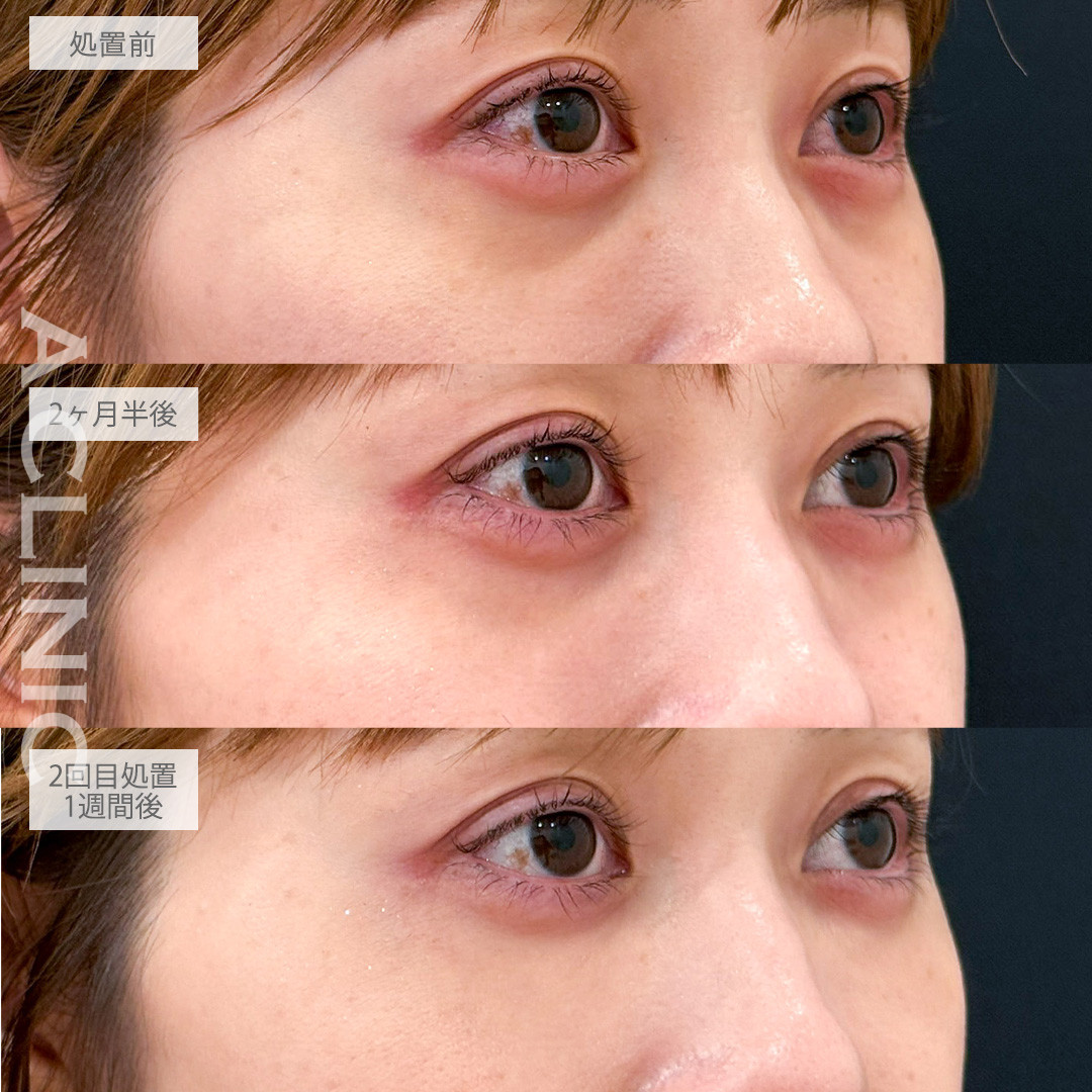 A式コンシーラー注射で目の下の色味とへこみを改善できました！こちら処置前から2回目処置1週間後の症例です(30代女性)