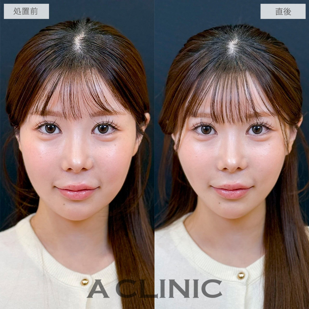 Aスレッドでたるみを引き上げ中顔面も短く見えるようになりました！処置前と直後の症例です(20代女性)