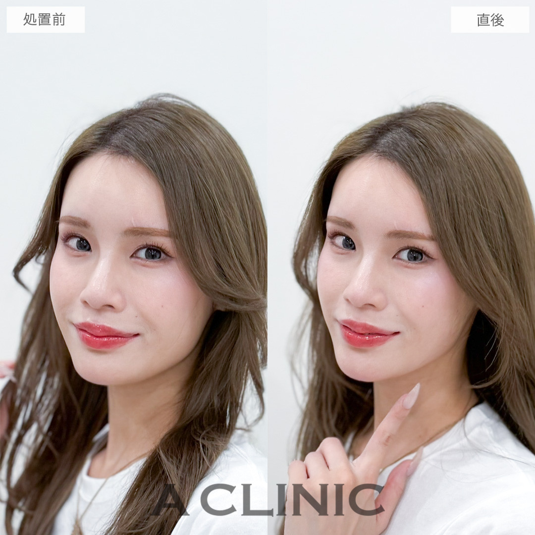 Aスレッドでキュッと引き締まった小顔を再現！処置前と直後の症例です(30代女性)