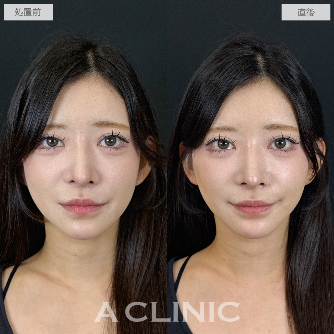 Aスレッドでたるみやもたつきをギュギュっとリフトアップ！こちら処置前と直後の症例です(20代女性)