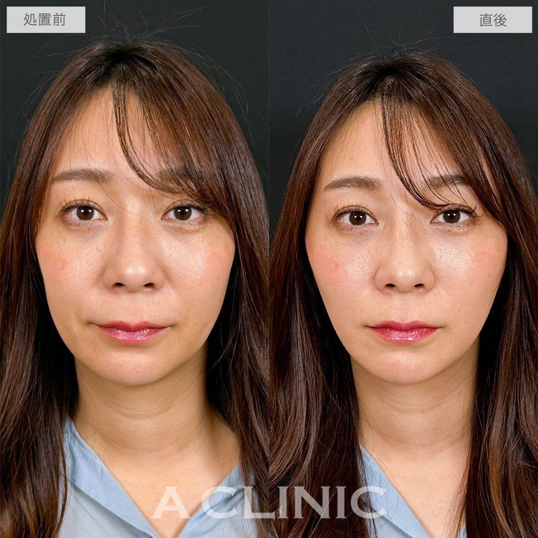 Aスレッドで口周りのもたつきを重点的にケアし自然な若返りを叶えました！こちら処置前と直後の症例です(30代女性)