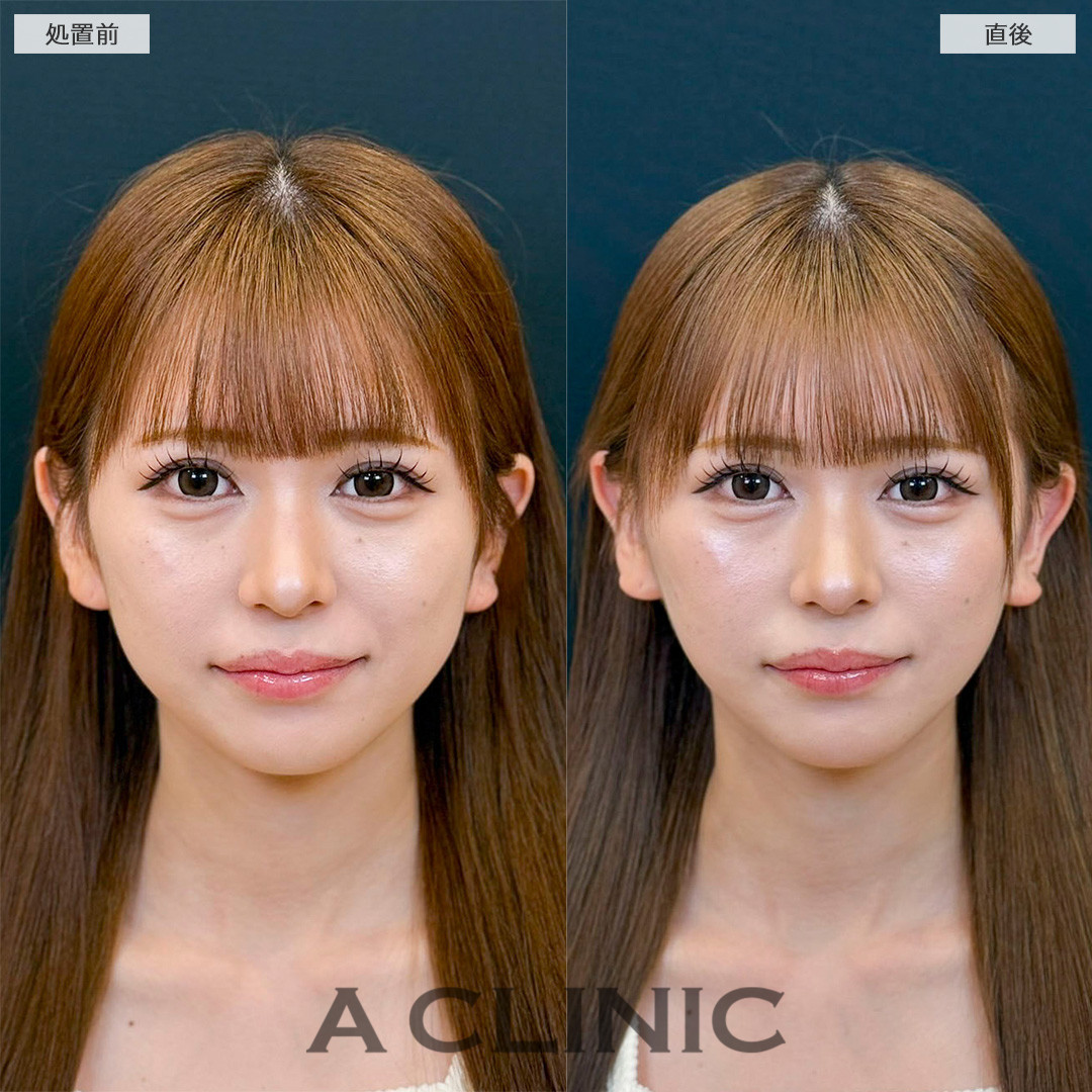 Aスレッドは今あるたるみだけでなく将来のたるみ予防としてもおすすめです！処置前と直後の症例です(20代女性)