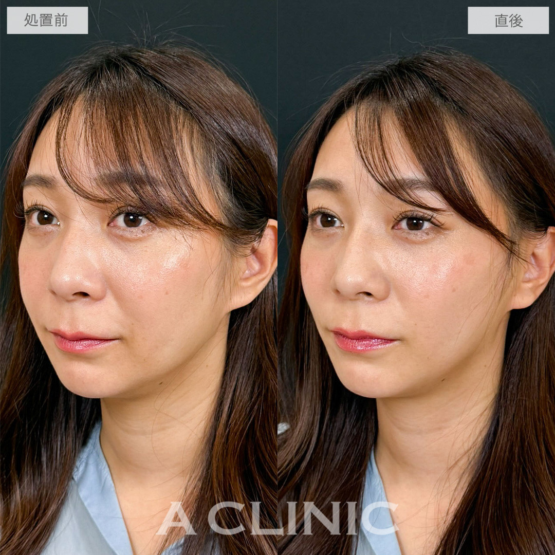 Aスレッドで口周りのもたつきを重点的にケアし自然な若返りを叶えました！こちら処置前と直後の症例です(30代女性)