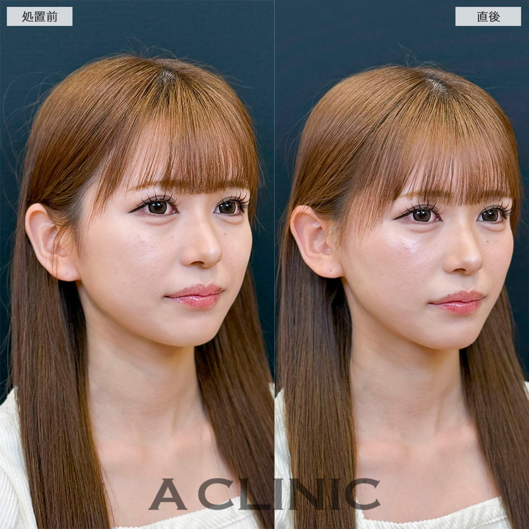 Aスレッドは今あるたるみだけでなく将来のたるみ予防としてもおすすめです！処置前と直後の症例です(20代女性)