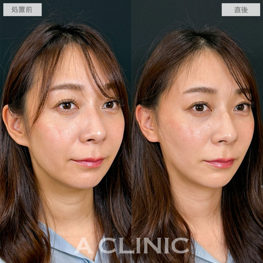 Aスレッドで口周りのもたつきを重点的にケアし自然な若返りを叶えました！こちら処置前と直後の症例です(30代女性)