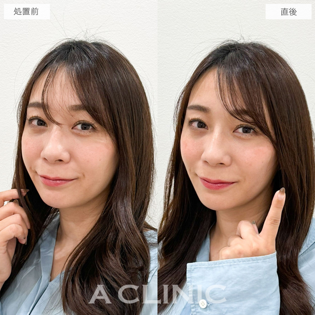 Aスレッドで口周りのもたつきを重点的にケアし自然な若返りを叶えました！こちら処置前と直後の症例です(30代女性)