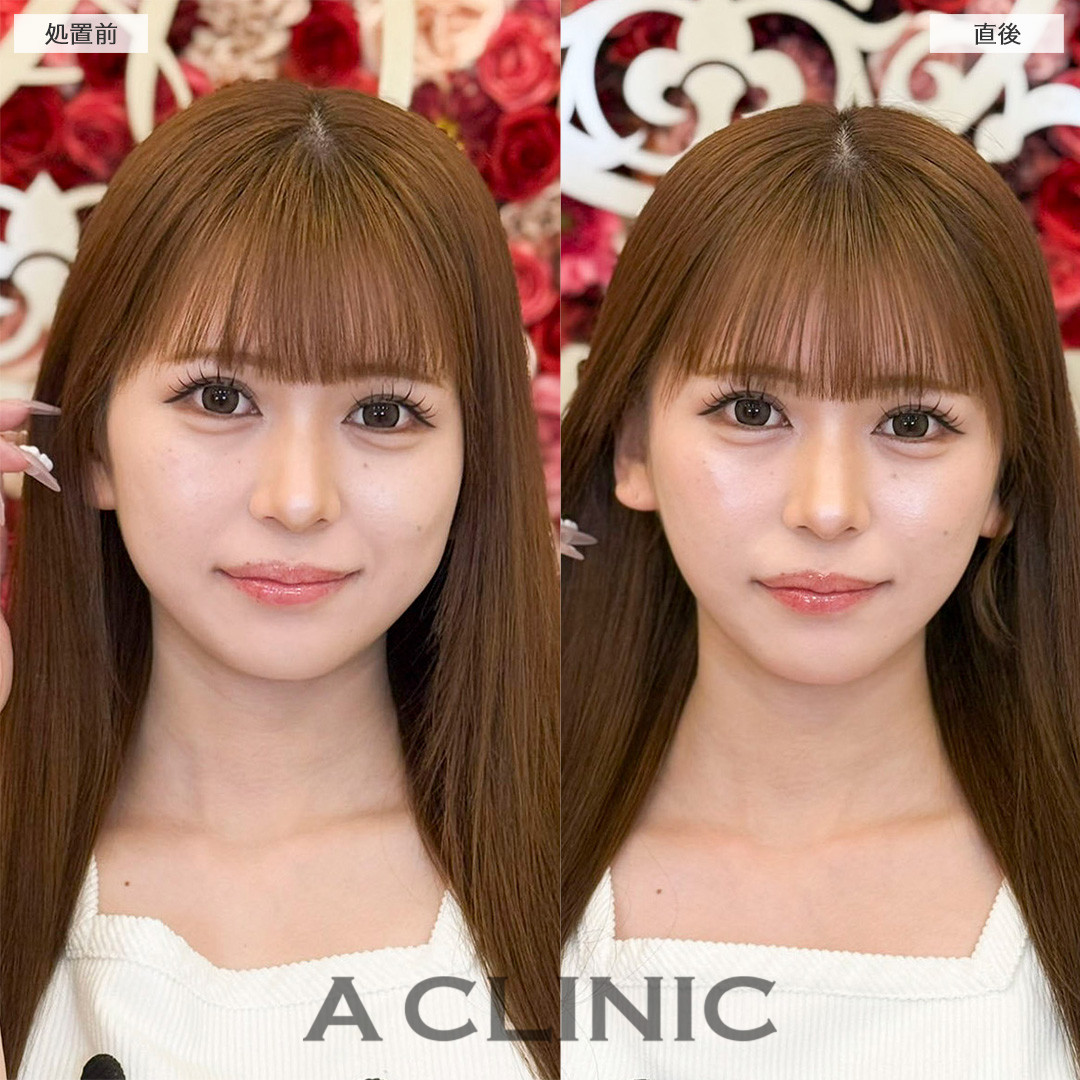 Aスレッドは今あるたるみだけでなく将来のたるみ予防としてもおすすめです！処置前と直後の症例です(20代女性)