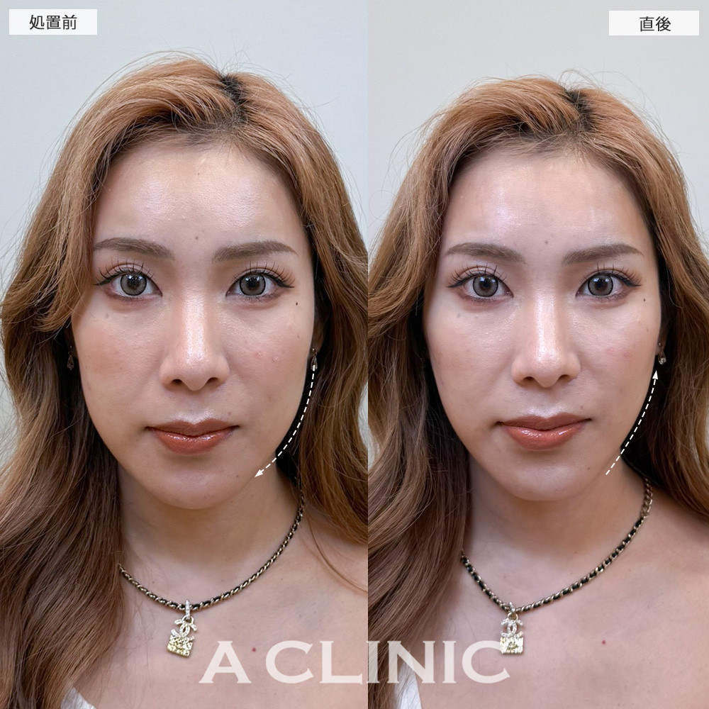 Aスレッドで直後から輪郭スッキリしバランスの整った輪郭に！こちら処置前と直後の症例です(20代女性)