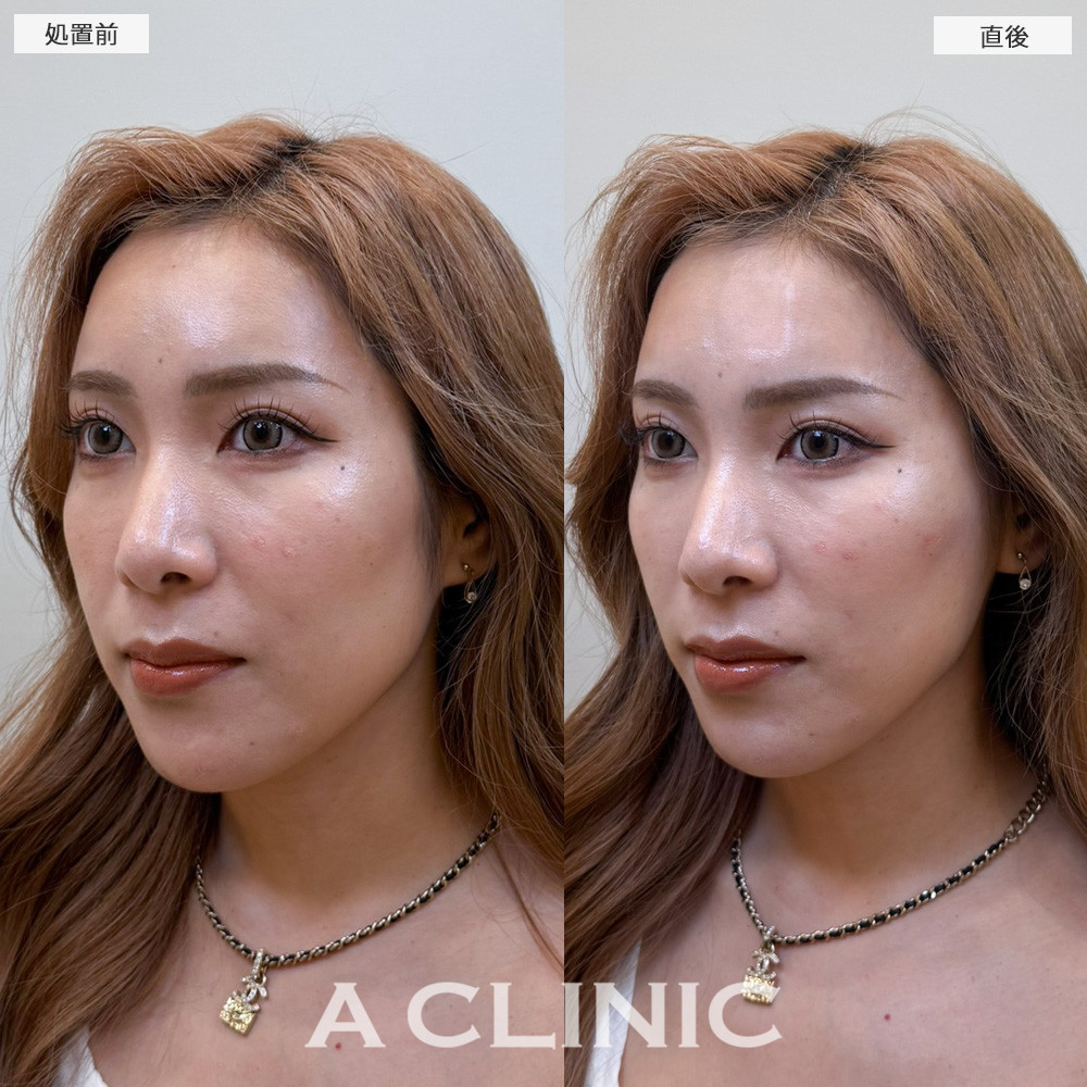 Aスレッドで直後から輪郭スッキリしバランスの整った輪郭に！こちら処置前と直後の症例です(20代女性)