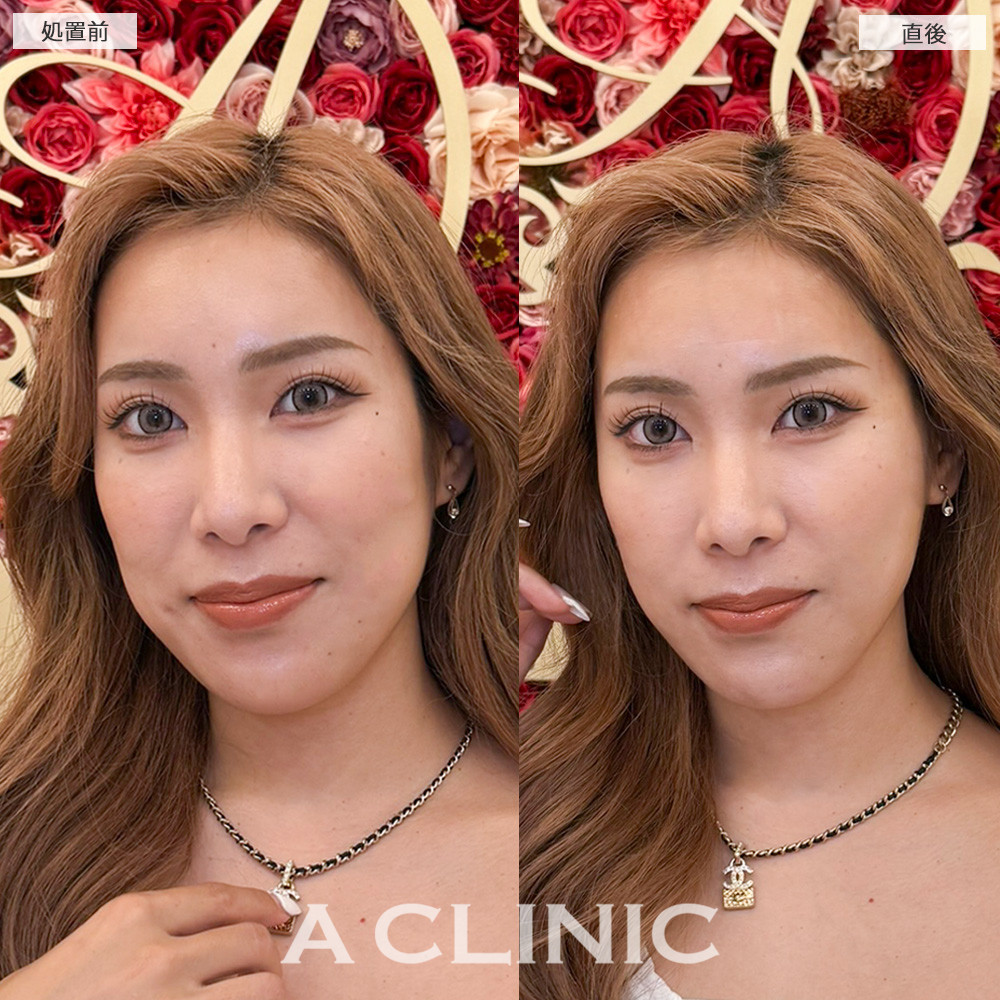 Aスレッドで直後から輪郭スッキリしバランスの整った輪郭に！こちら処置前と直後の症例です(20代女性)