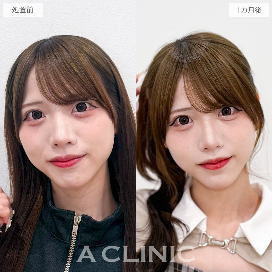 ヒアルロン酸カスタマイズメニューは一気にお顔のお悩みを解消できる施術です！こちら処置前と1か月後の症例です(20代女性)