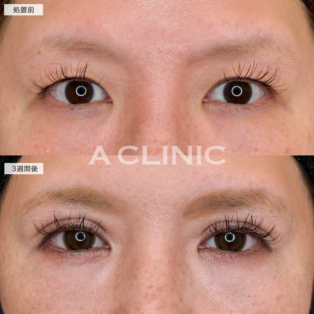 二重術埋没法で安定した二重になって目力アップしました！処置前から3週間後の症例です(40代女性)