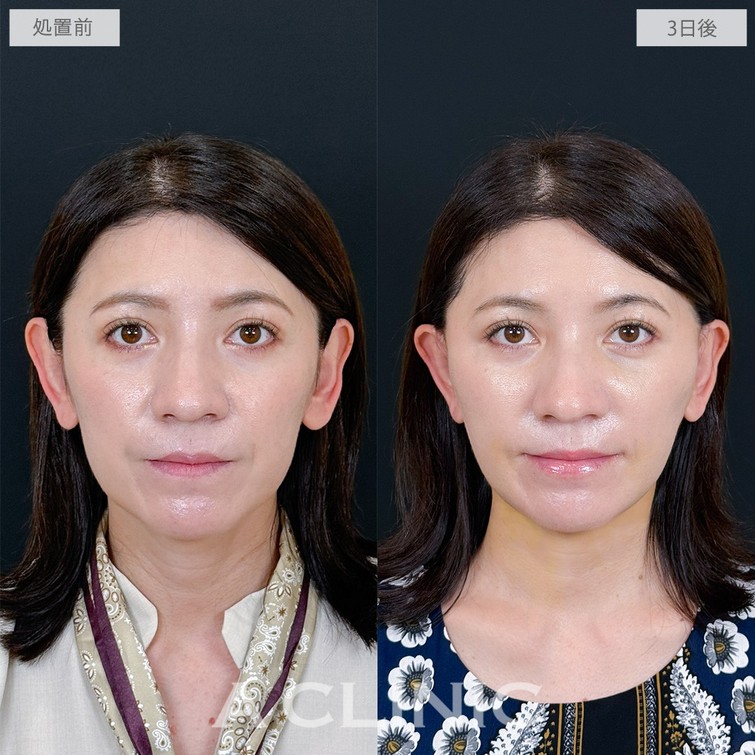 A式ナゾラリフトでほうれい線と輪郭のたるみを同時に軽減できます！処置前と3日後の症例です(40代女性)