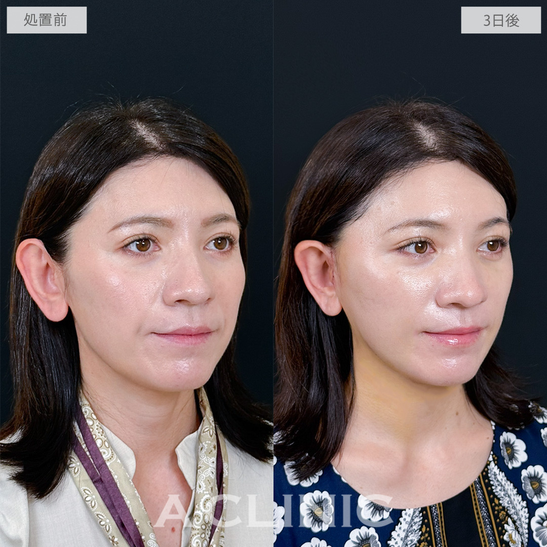 A式ナゾラリフトでほうれい線と輪郭のたるみを同時に軽減できます！処置前と3日後の症例です(40代女性)