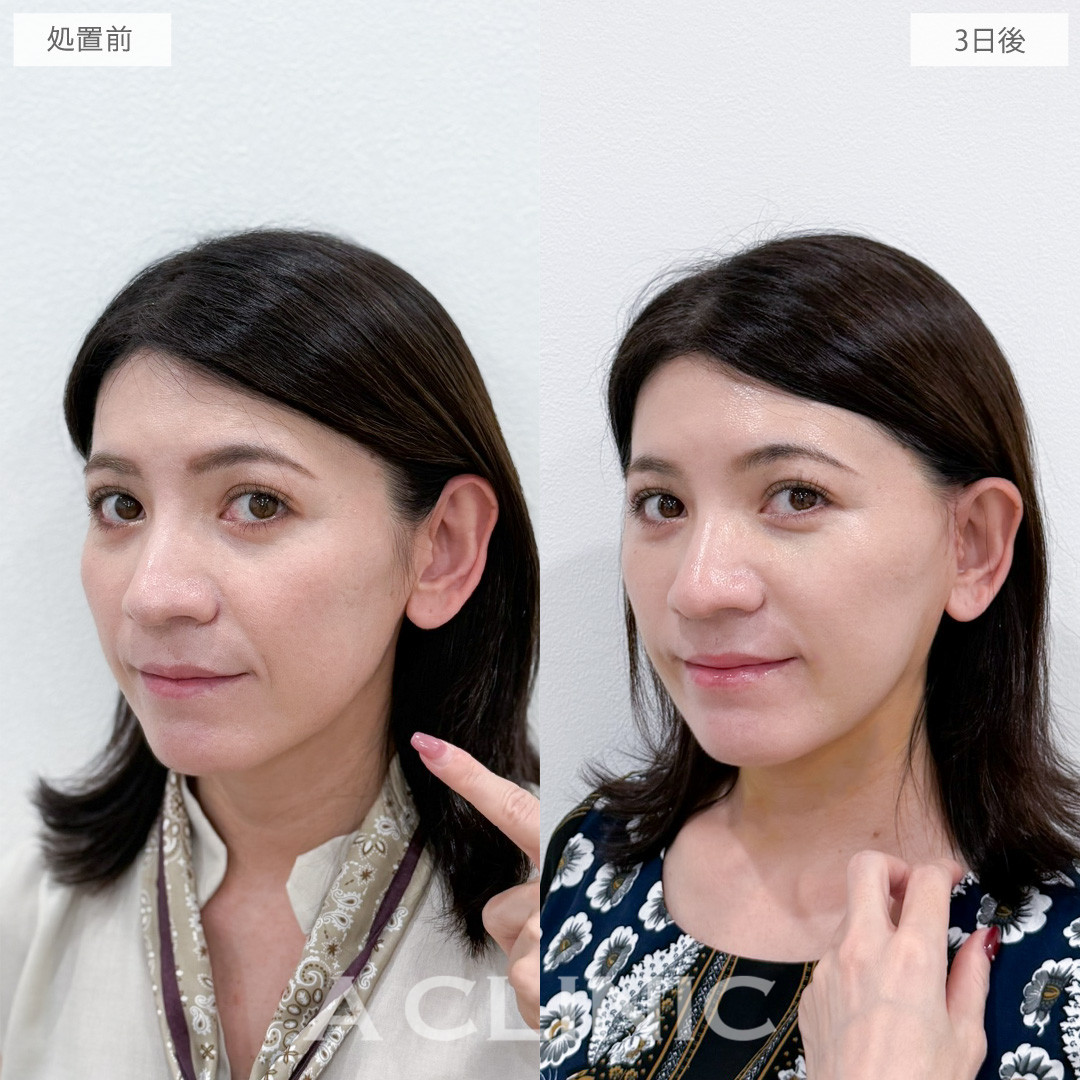 A式ナゾラリフトでほうれい線と輪郭のたるみを同時に軽減できます！処置前と3日後の症例です(40代女性)