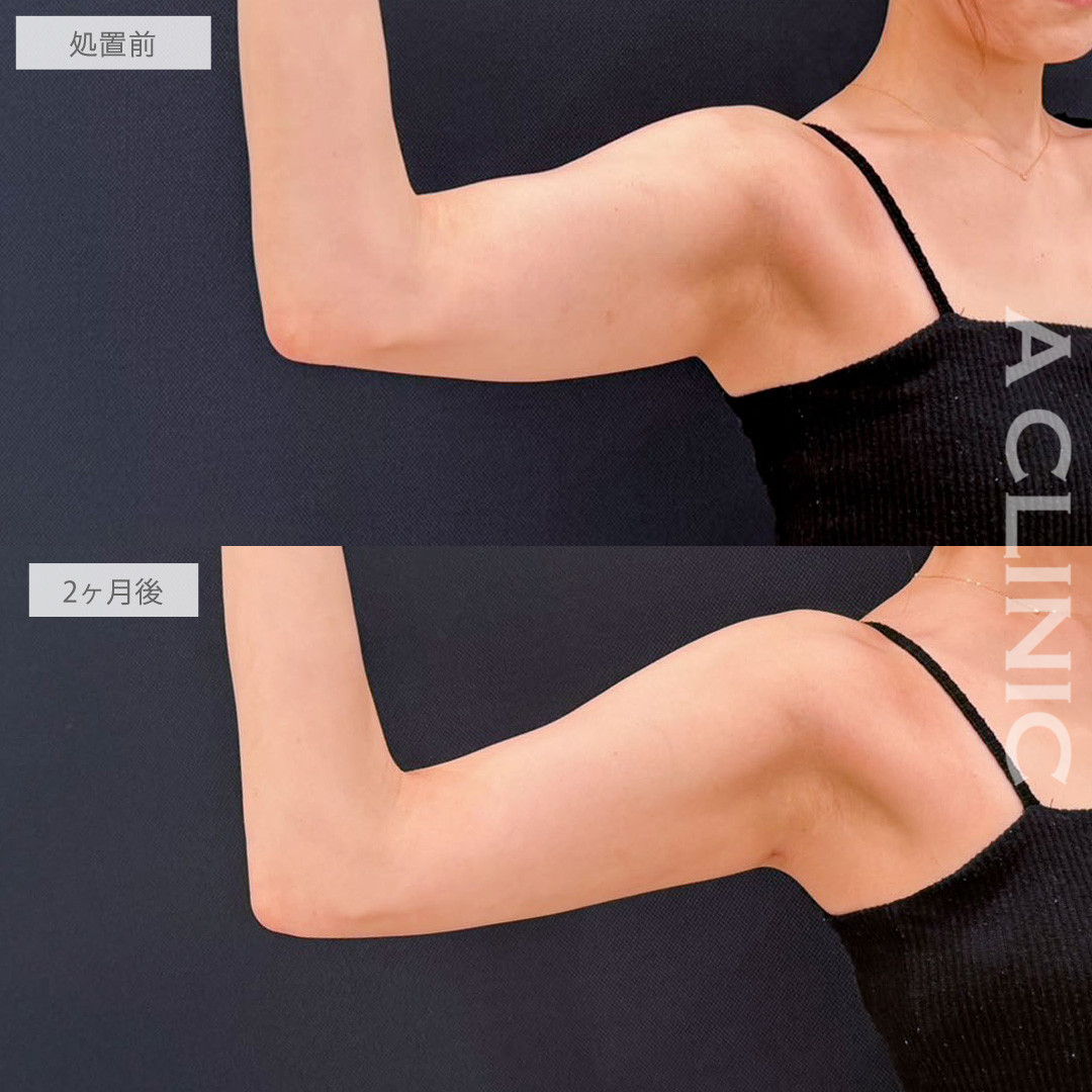二の腕スリム脂肪吸引でゆがみのない真っ直ぐな二の腕に！こちら処置前と2か月後の症例です(20代女性)