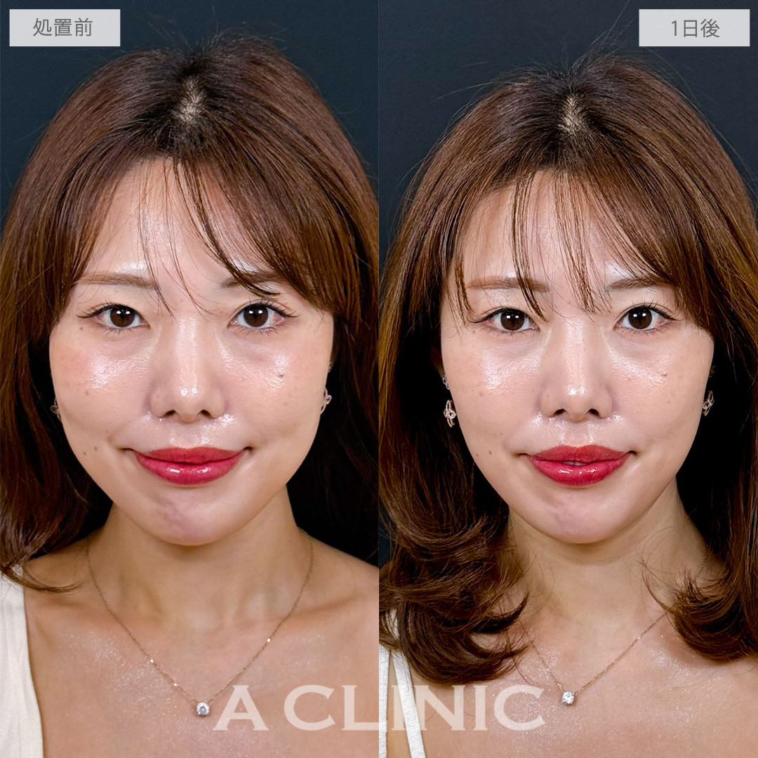 1day小顔脂肪吸引は直後から腫れずにしっかり小顔を実感できます！こちら処置前から1日後の症例です(30代女性)