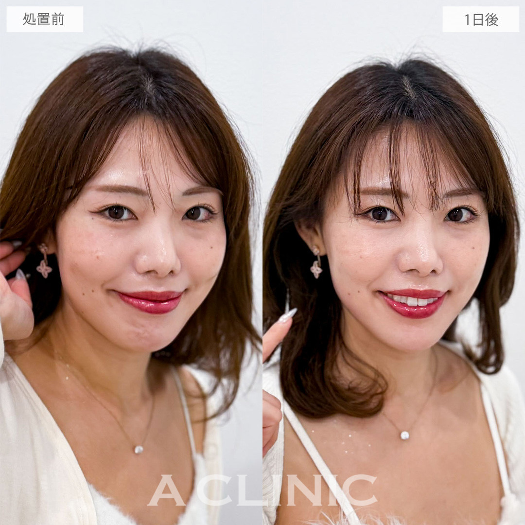 1day小顔脂肪吸引は直後から腫れずにしっかり小顔を実感できます！こちら処置前から1日後の症例です(30代女性)