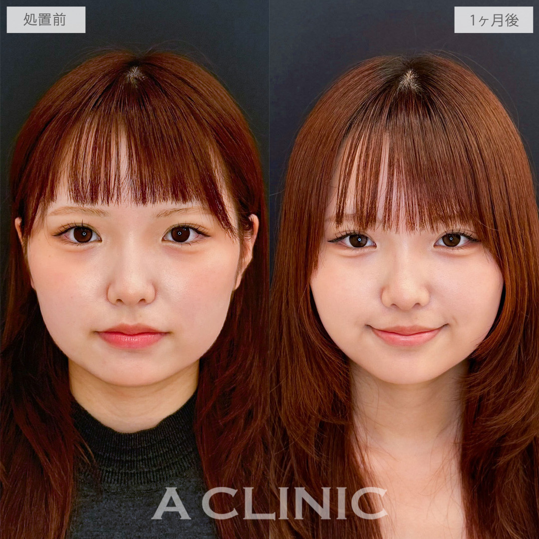 1day小顔脂肪吸引で丸顔の愛らしさは残しつつもたつきを綺麗にリセット！こちら処置前と1か月後の症例です(10代女性)
