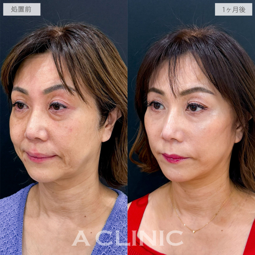 A式ナゾラリフトで品のある自然な若々しさを取り戻しました！こちら処置前から2か月後の症例です(50代女性)