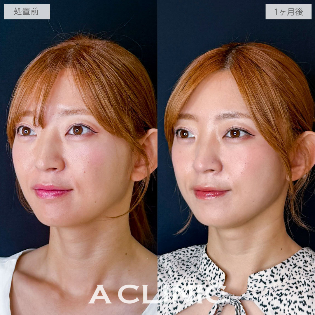 1day小顔脂肪吸引で気になりだしたもたつきを解消できました！こちら処置前から1か月後の症例です(30代女性)