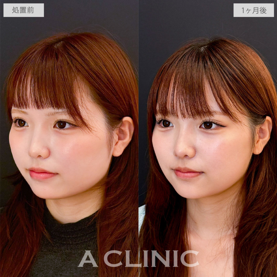 1day小顔脂肪吸引で丸顔の愛らしさは残しつつもたつきを綺麗にリセット！こちら処置前と1か月後の症例です(10代女性)