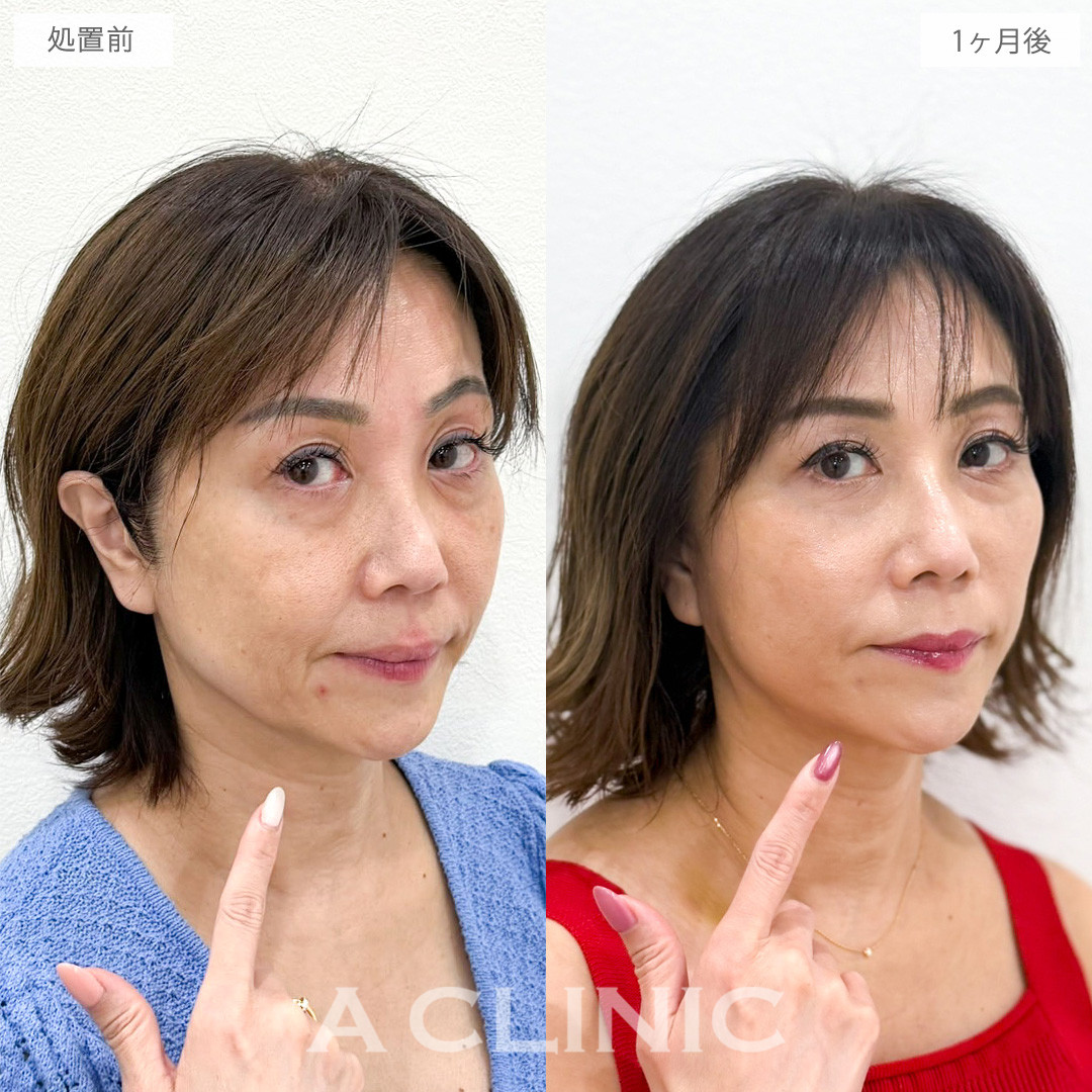A式ナゾラリフトで品のある自然な若々しさを取り戻しました！こちら処置前から2か月後の症例です(50代女性)