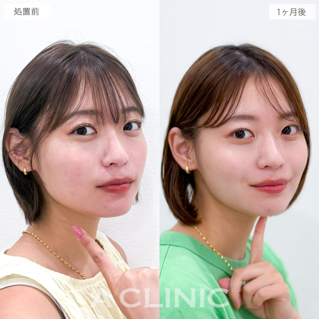 1day小顔脂肪吸引と小顔エラボトックスでフェイスラインを整えお顔のボリュームダウン！こちら処置前と1か月後の症例です(20代女性)