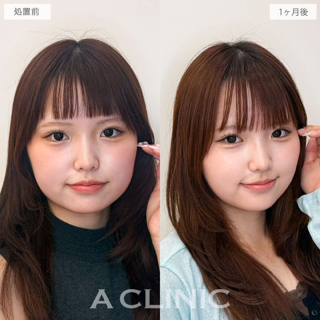1day小顔脂肪吸引で丸顔の愛らしさは残しつつもたつきを綺麗にリセット！こちら処置前と1か月後の症例です(10代女性)