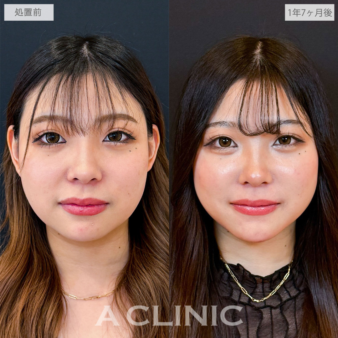 1day小顔脂肪吸引でフェイスラインからあご下まで脂肪をなくせました！こちら処置前と1年7ヶ月後の症例です(20代女性)