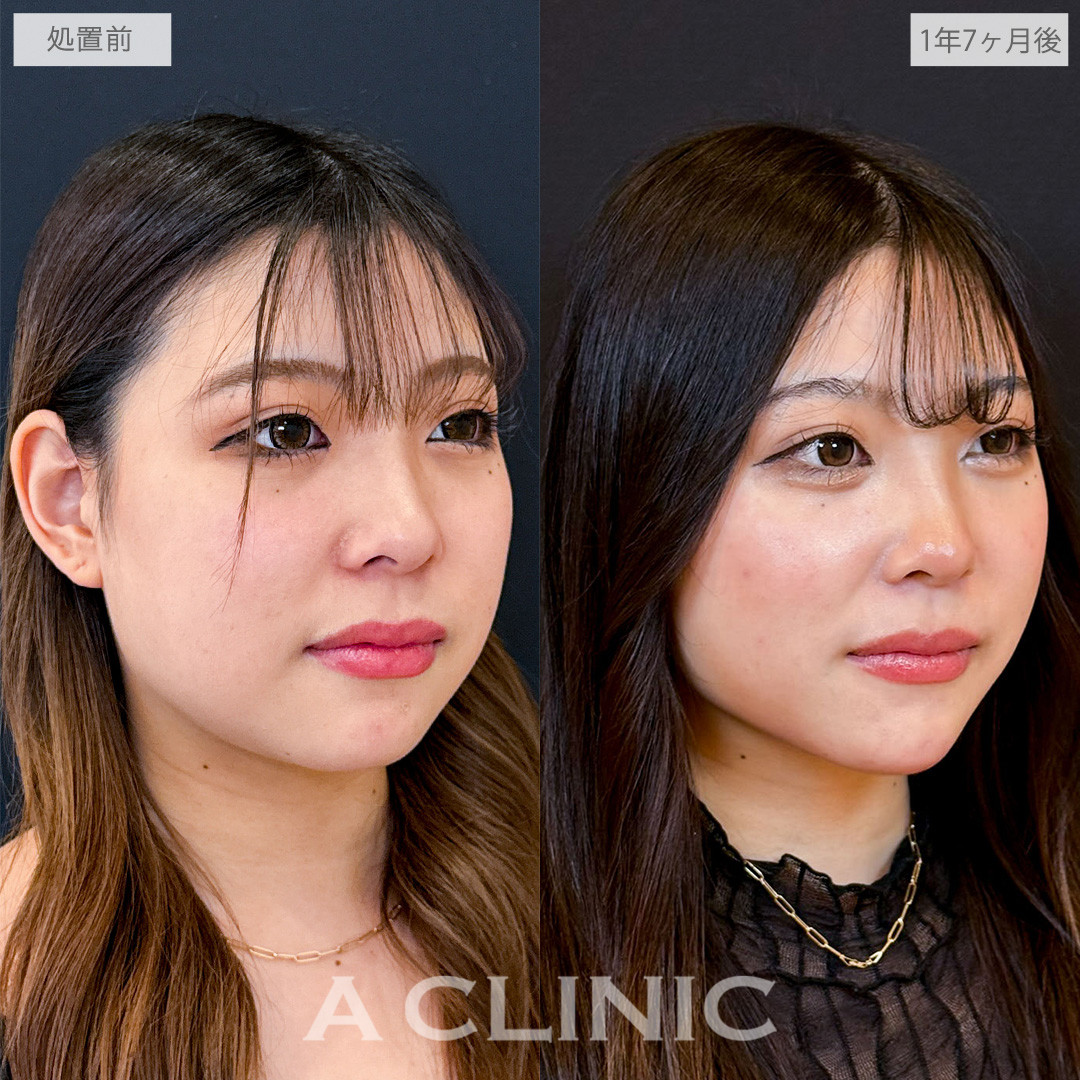 1day小顔脂肪吸引でフェイスラインからあご下まで脂肪をなくせました！こちら処置前と1年7ヶ月後の症例です(20代女性)