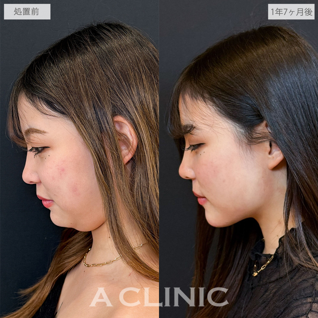 1day小顔脂肪吸引でフェイスラインからあご下まで脂肪をなくせました！こちら処置前と1年7ヶ月後の症例です(20代女性)