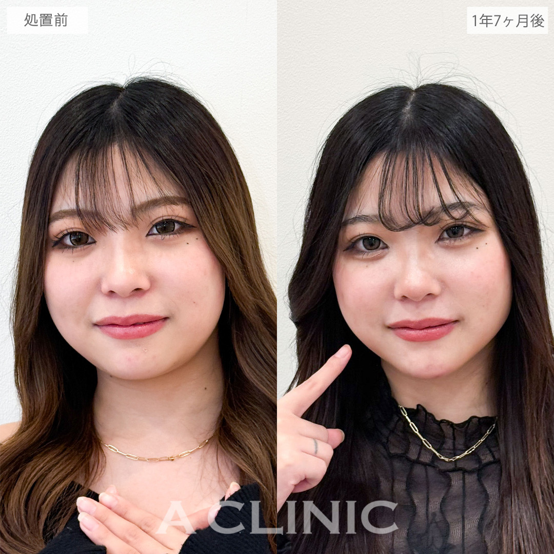 1day小顔脂肪吸引でフェイスラインからあご下まで脂肪をなくせました！こちら処置前と1年7ヶ月後の症例です(20代女性)
