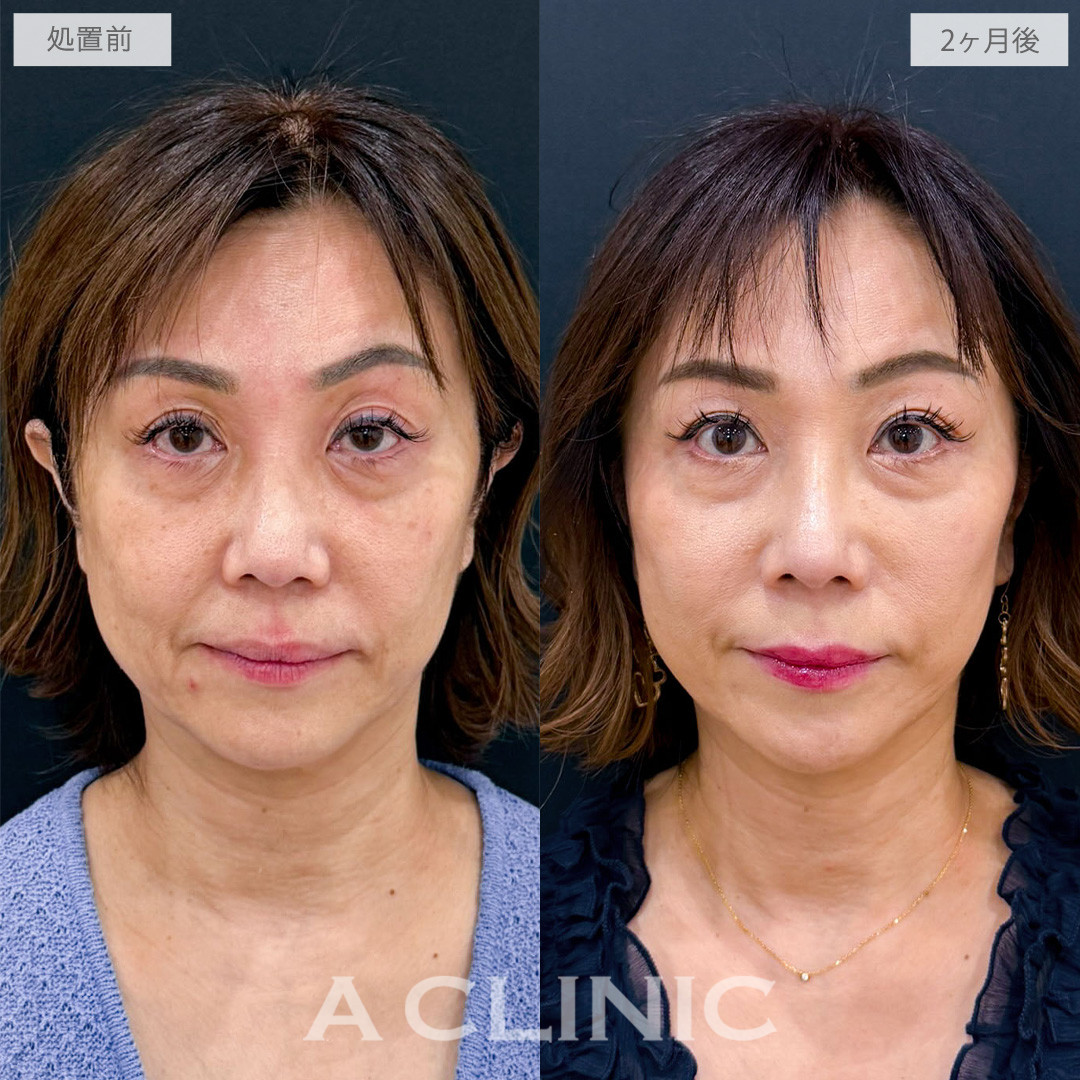 A式ナゾラリフトで品のある自然な若々しさを取り戻しました！こちら処置前から2か月後の症例です(50代女性)