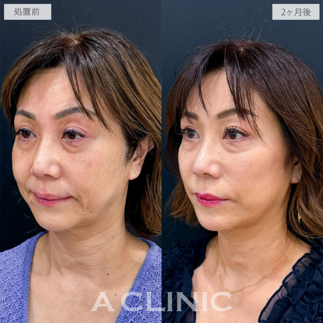 A式ナゾラリフトで品のある自然な若々しさを取り戻しました！こちら処置前から2か月後の症例です(50代女性)