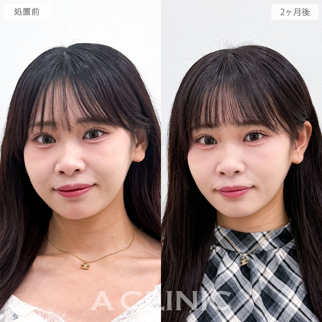 1day小顔脂肪吸引でエラ下アゴ下のお肉を減らして極上のメリハリ小顔に！こちら処置前と2か月後の症例です(20代女性)